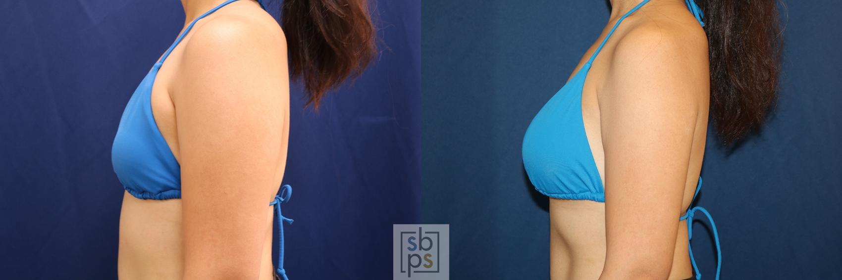 Before & After Breast Augmentation Case 620 Bikini Left  View in Torrance & Los Angeles, CA, CA
