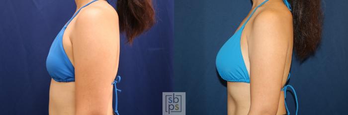 Before & After Breast Augmentation Case 620 Bikini Left  View in Torrance, CA