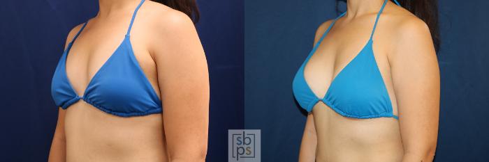 Before & After Breast Augmentation Case 620 Bikini Left Oblique View in Torrance, CA