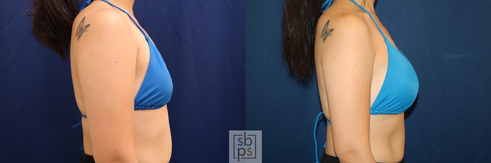 Before & After Breast Augmentation Case 620 Bikini Right View in Torrance & Los Angeles, CA, CA