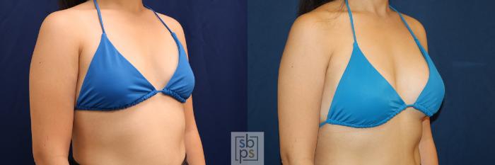 Before & After Breast Augmentation Case 620 Bikini Right Oblique View in Torrance, CA
