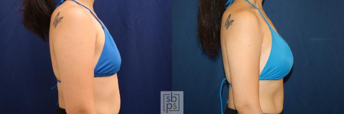 Before & After Breast Augmentation Case 620 Bikini Right View in Torrance, CA