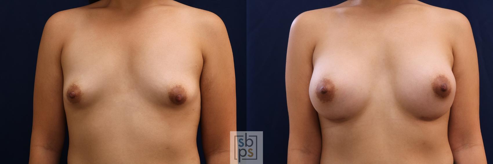 Before & After Breast Augmentation Case 620 Front View in Torrance, CA