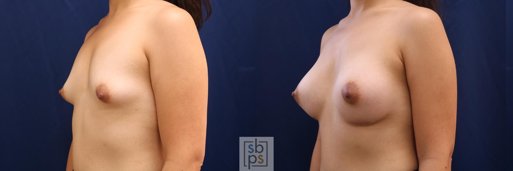 Before & After Breast Augmentation Case 620 Left Oblique View in Torrance & Los Angeles, CA, CA