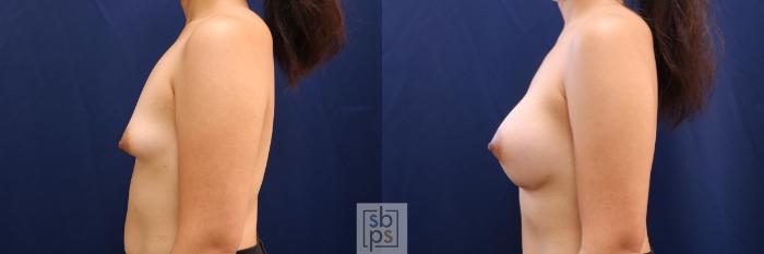 Before & After Breast Augmentation Case 620 Left Side View in Torrance, CA