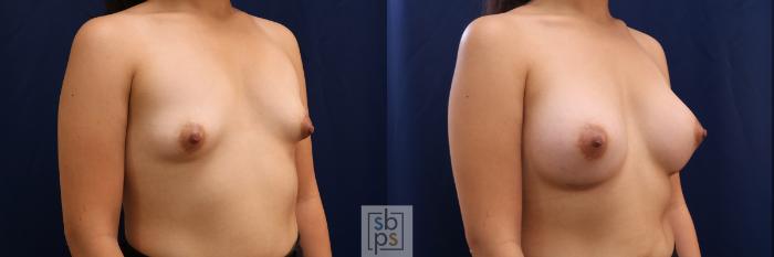Before & After Breast Augmentation Case 620 Right Oblique View in Torrance, CA