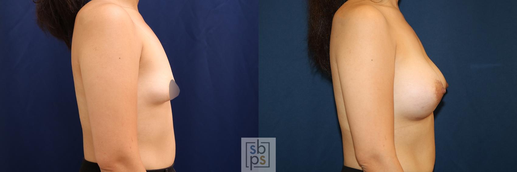 Before & After Breast Augmentation Case 620 Right Side View in Torrance & Los Angeles, CA, CA