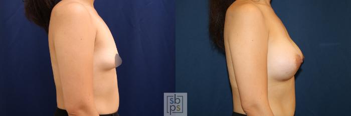 Before & After Breast Augmentation Case 620 Right Side View in Torrance, CA