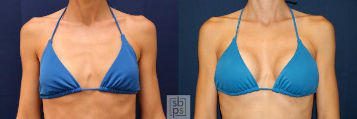 Before & After Breast Augmentation Case 623 Bikini Front View in Torrance, CA