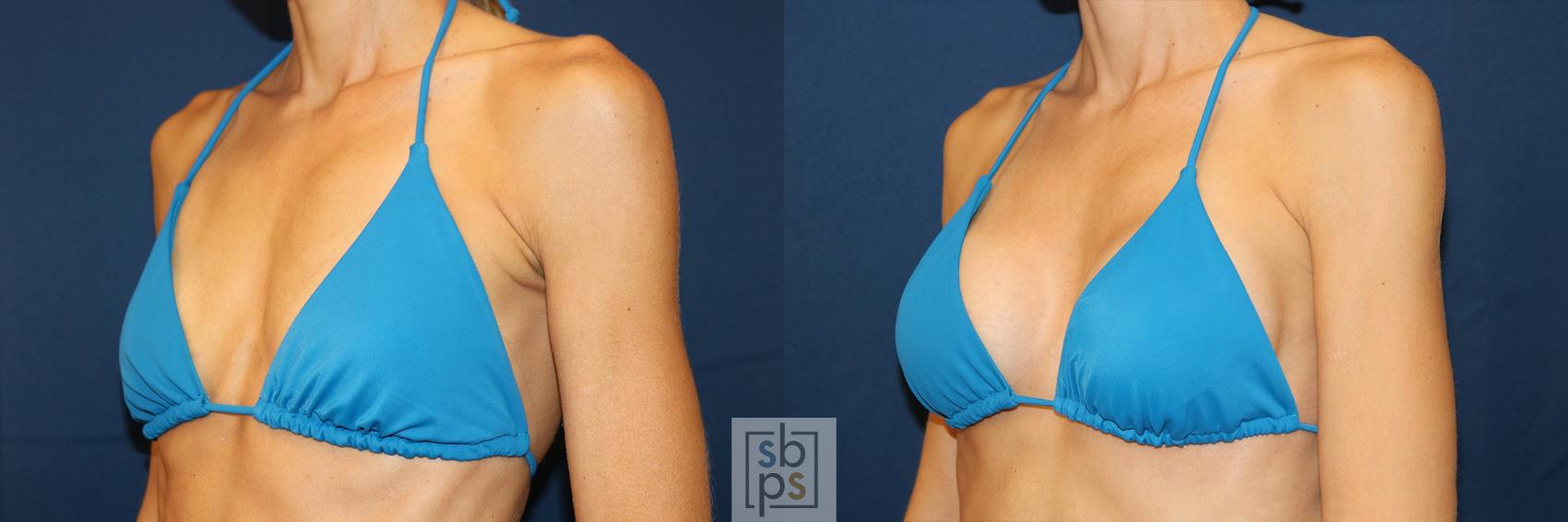 Before & After Breast Augmentation Case 623 Bikini Left Oblique View in Torrance & Los Angeles, CA, CA