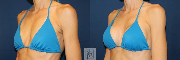 Before & After Breast Augmentation Case 623 Bikini Left Oblique View in Torrance, CA