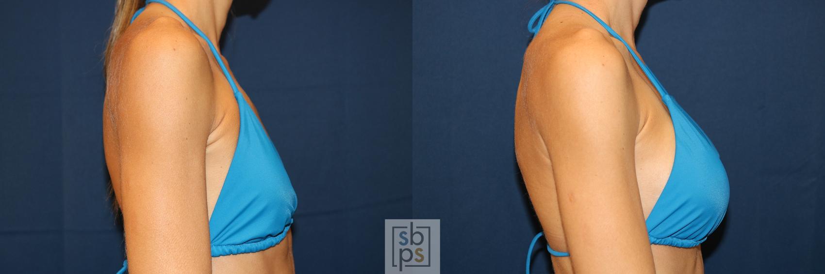 Before & After Breast Augmentation Case 623 Bikini Right View in Torrance & Los Angeles, CA, CA