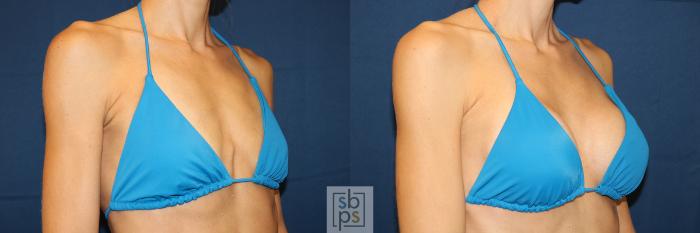 Before & After Breast Augmentation Case 623 Bikini Right Oblique View in Torrance, CA