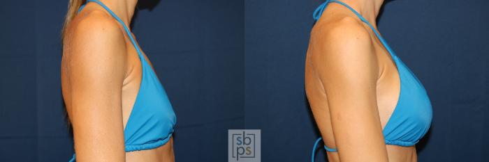 Before & After Breast Augmentation Case 623 Bikini Right View in Torrance, CA