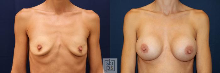 Before & After Breast Augmentation Case 623 Front View in Torrance, CA