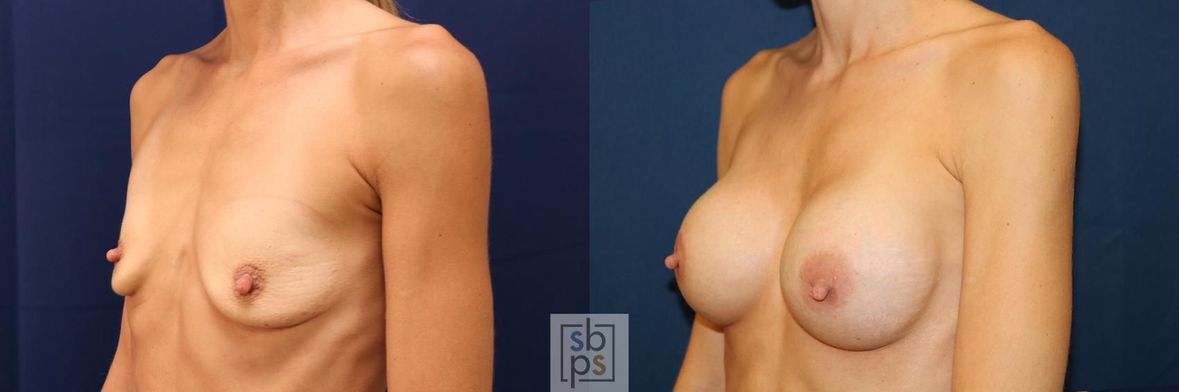 Before & After Breast Augmentation Case 623 Left Oblique View in Los Angeles & Torrance, CA, CA