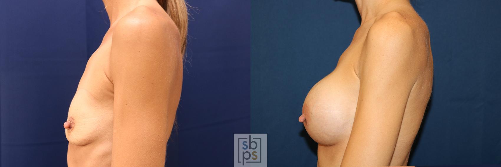 Before & After Breast Augmentation Case 623 Left Side View in Los Angeles & Torrance, CA, CA