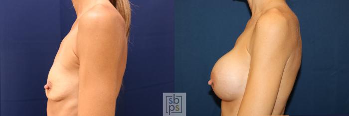 Before & After Breast Augmentation Case 623 Left Side View in Torrance, CA