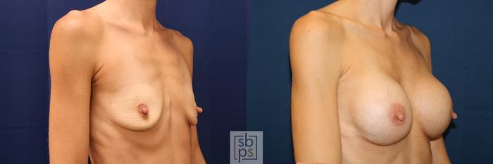 Before & After Breast Augmentation Case 623 Right Oblique View in Torrance, CA