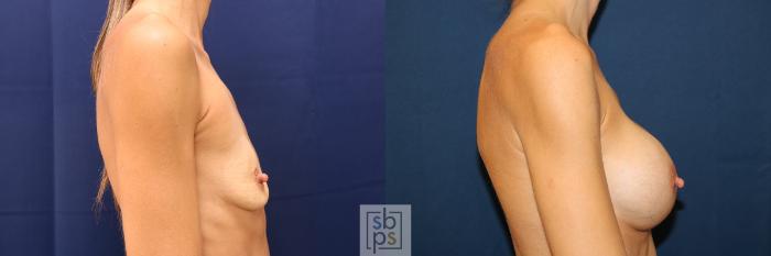 Before & After Breast Augmentation Case 623 Right Side View in Torrance, CA