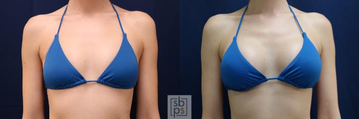 Before & After Breast Augmentation Case 635 Bikini Front View in Torrance, CA