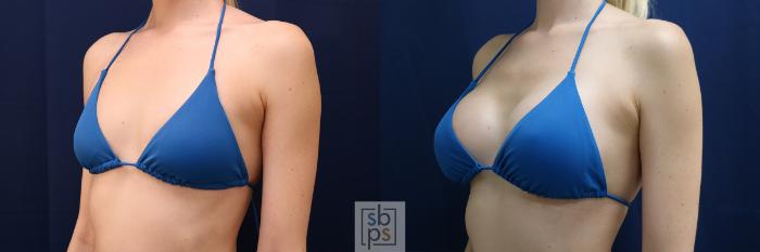 Before & After Breast Augmentation Case 635 Bikini Left Oblique View in Torrance, CA
