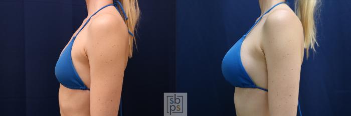 Before & After Breast Augmentation Case 635 Bikini Left View in Torrance, CA
