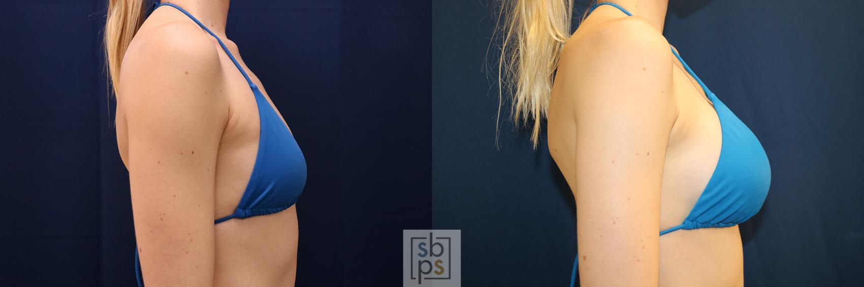 Before & After Breast Augmentation Case 635 Bikini Right View in Torrance & Los Angeles, CA, CA