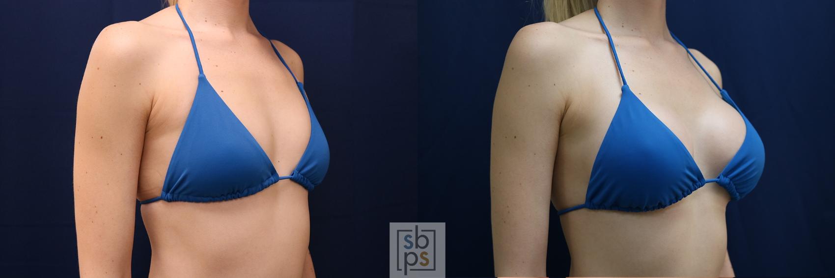 Before & After Breast Augmentation Case 635 Bikini Right Oblique View in Torrance & Los Angeles, CA, CA