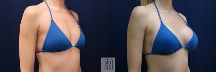 Before & After Breast Augmentation Case 635 Bikini Right Oblique View in Torrance, CA