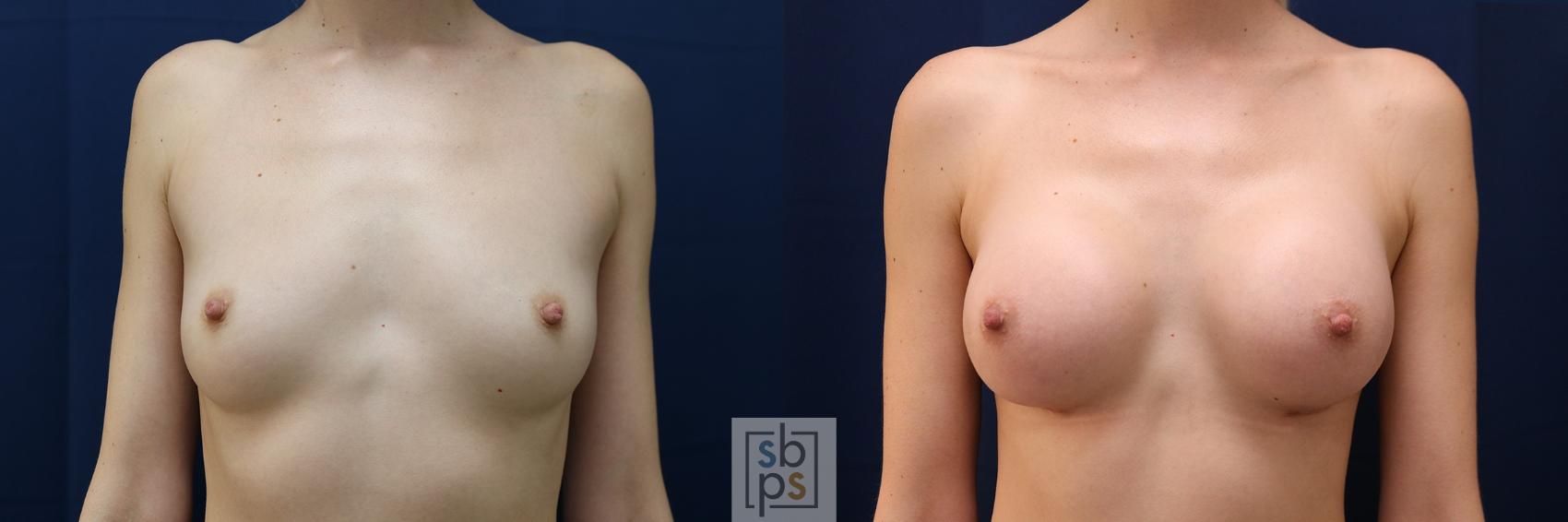 Before & After Breast Augmentation Case 635 Front View in Torrance, CA