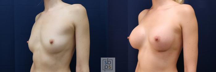 Before & After Breast Augmentation Case 635 Left Oblique View in Torrance, CA