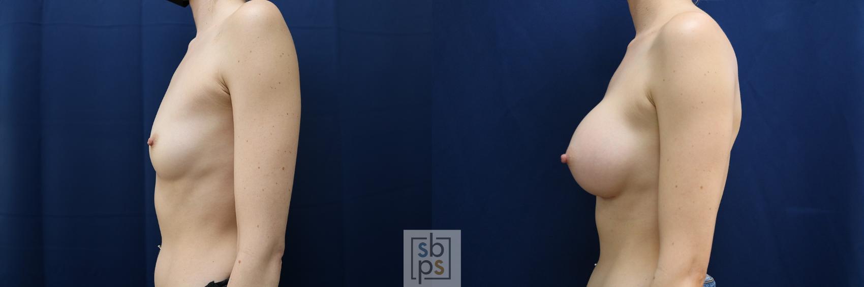 Before & After Breast Augmentation Case 635 Left Side View in Torrance & Los Angeles, CA, CA