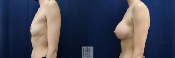 Before & After Breast Augmentation Case 635 Left Side View in Torrance, CA