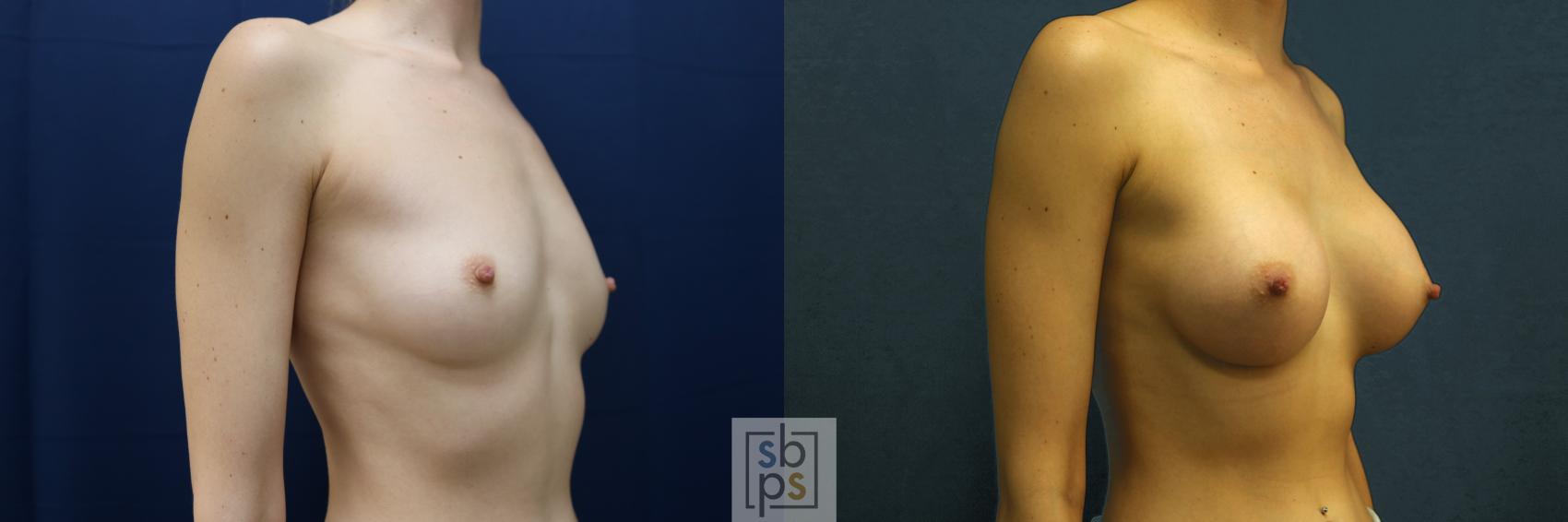 Before & After Breast Augmentation Case 635 Right Oblique View in Torrance & Los Angeles, CA, CA