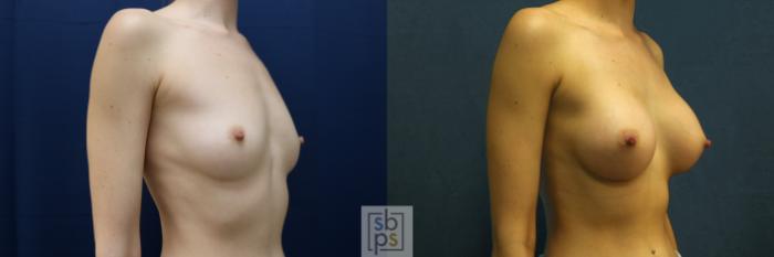 Before & After Breast Augmentation Case 635 Right Oblique View in Torrance, CA