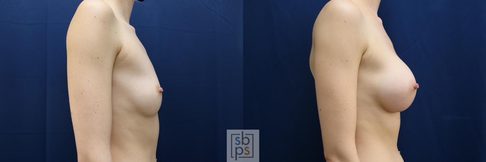 Before & After Breast Augmentation Case 635 Right Side View in Torrance & Los Angeles, CA, CA