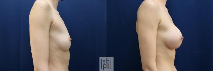 Before & After Breast Augmentation Case 635 Right Side View in Torrance, CA
