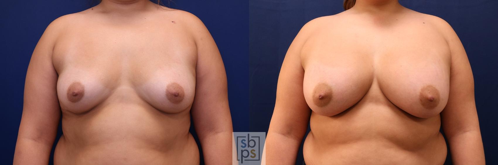 Before & After Breast Augmentation Case 636 Front View in Torrance, CA