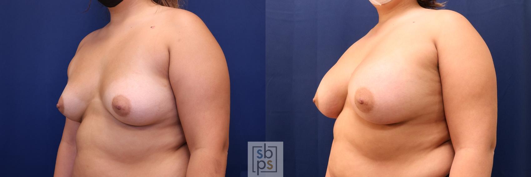 Before & After Breast Augmentation Case 636 Left Oblique View in Torrance & Los Angeles, CA, CA