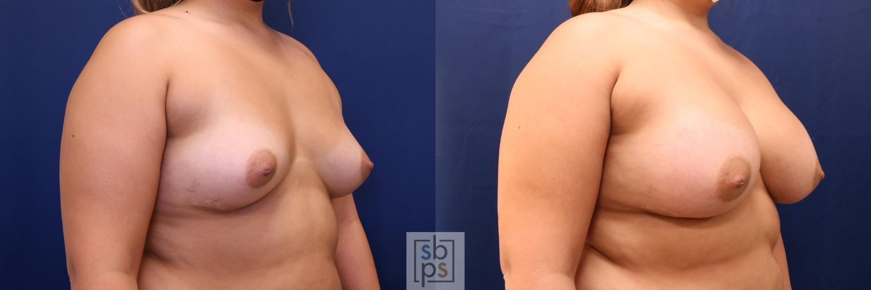 Before & After Breast Augmentation Case 636 Right Oblique View in Torrance & Los Angeles, CA, CA