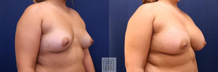 Before & After Breast Augmentation Case 636 Right Oblique View in Torrance, CA