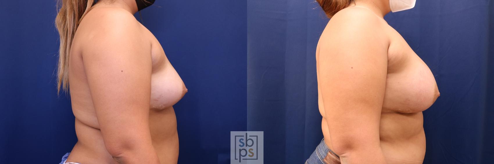 Before & After Breast Augmentation Case 636 Right Side View in Torrance & Los Angeles, CA, CA