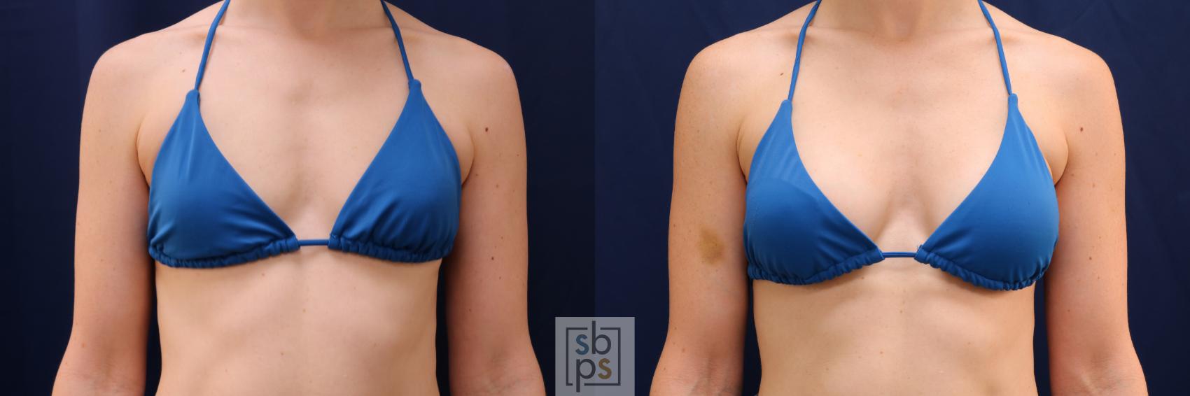 Before & After Breast Augmentation Case 641 Bikini Front View in Torrance & Los Angeles, CA, CA