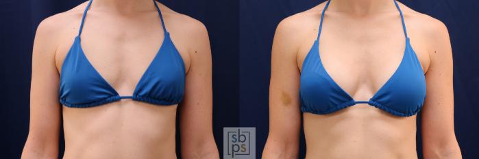 Before & After Breast Augmentation Case 641 Bikini Front View in Torrance, CA