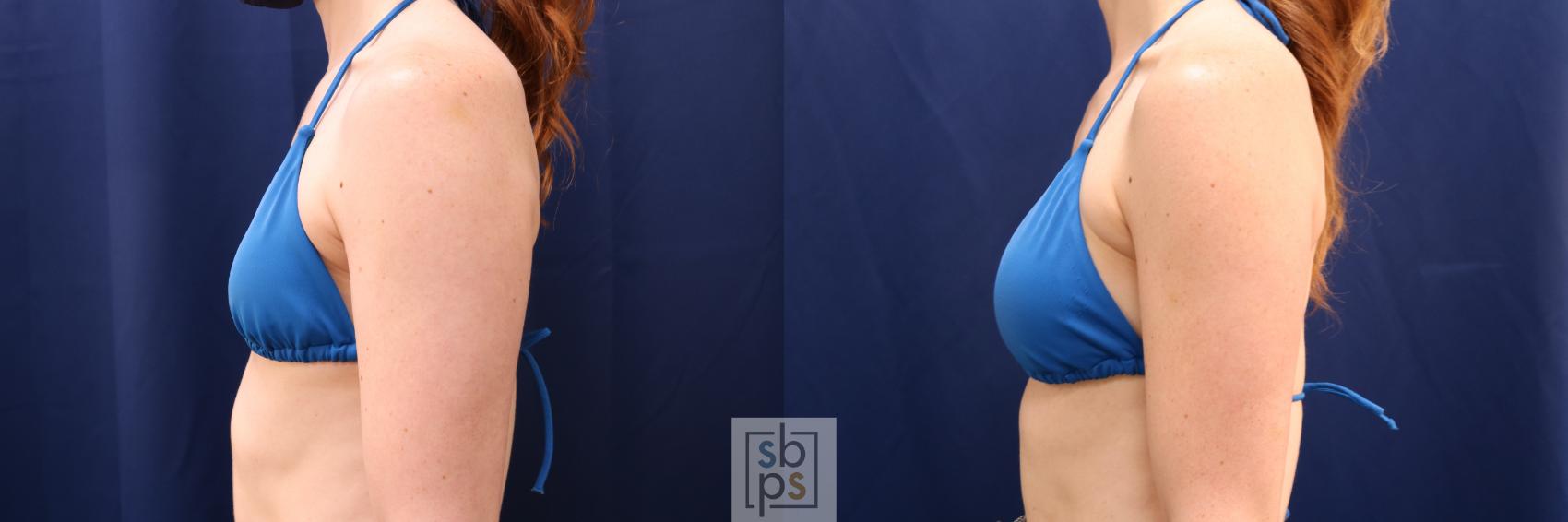 Before & After Breast Augmentation Case 641 Bikini Left View in Torrance & Los Angeles, CA, CA