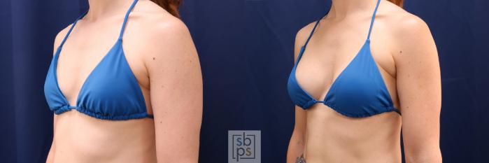 Before & After Breast Augmentation Case 641 Bikini Left Oblique View in Torrance, CA