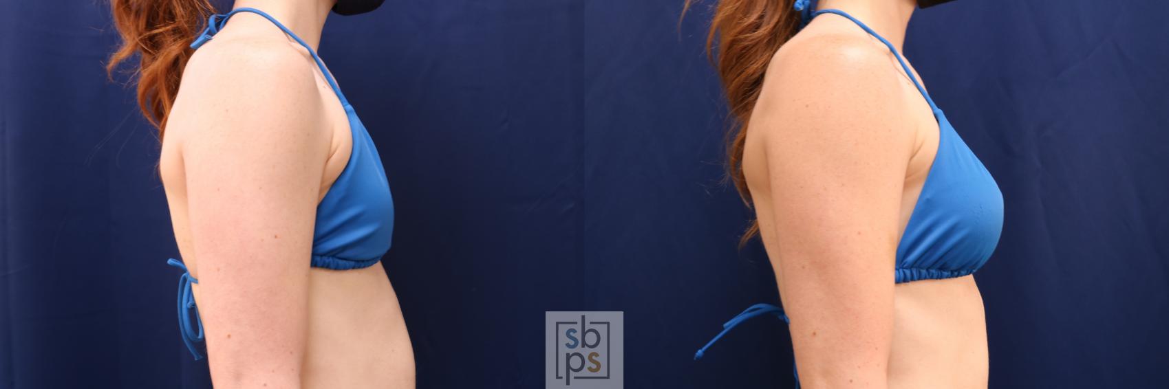 Before & After Breast Augmentation Case 641 Bikini Right View in Torrance & Los Angeles, CA, CA