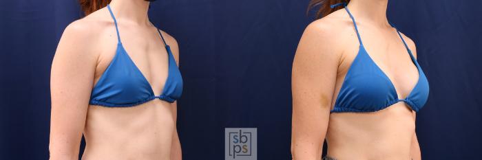 Before & After Breast Augmentation Case 641 Bikini Right Oblique View in Torrance, CA