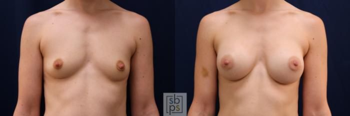 Before & After Breast Augmentation Case 641 Front View in Torrance, CA
